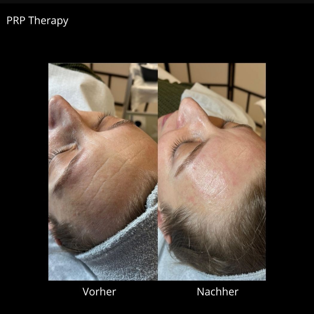 Microneedling Mirella Beauty PRE / ANTI AGING