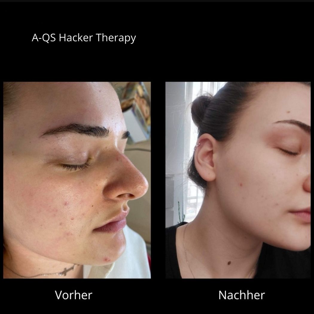 A-QS Hacker Akne Treatment Berlin