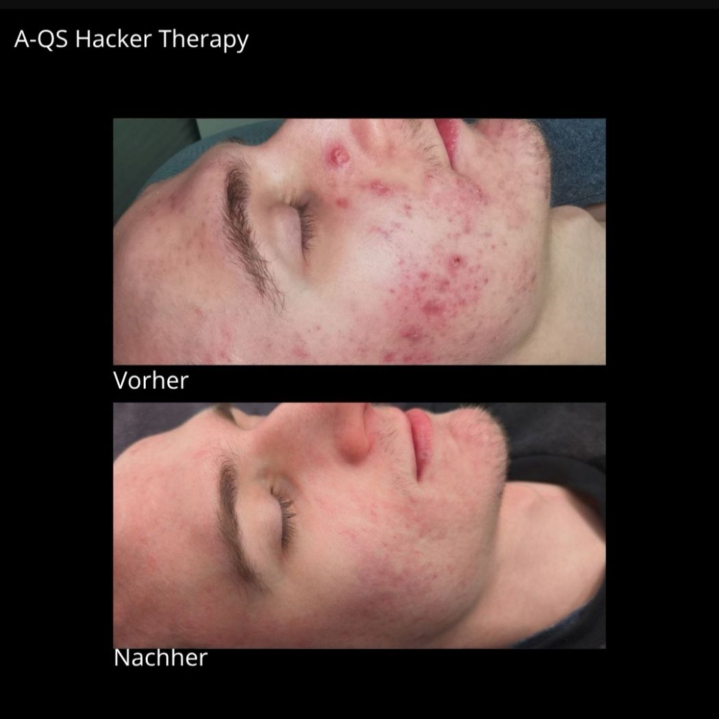 Gezielte Hautbehandlungen A-QS Hacker Akne Treatment Berlin