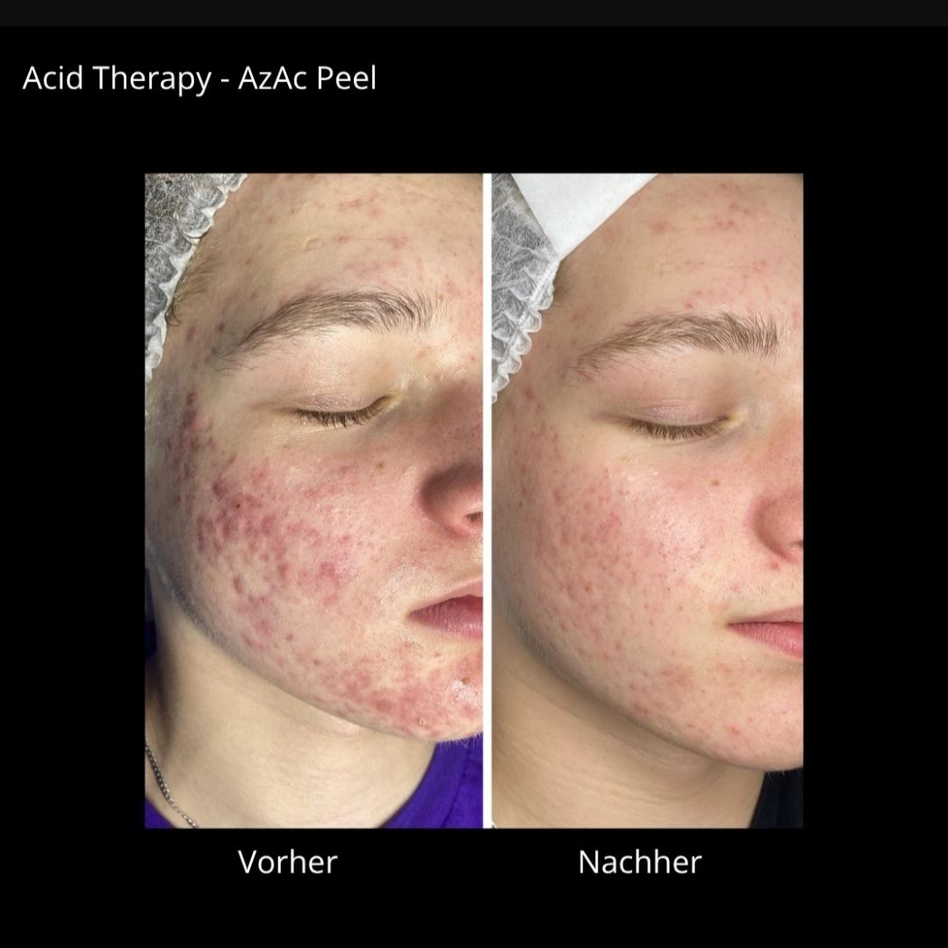 AzAc Akne Treatment