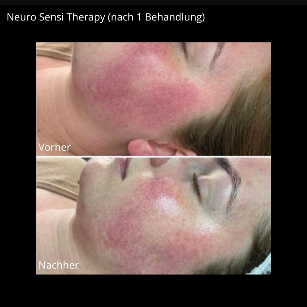 Neuro Sensi Treatment Mirella Beauty