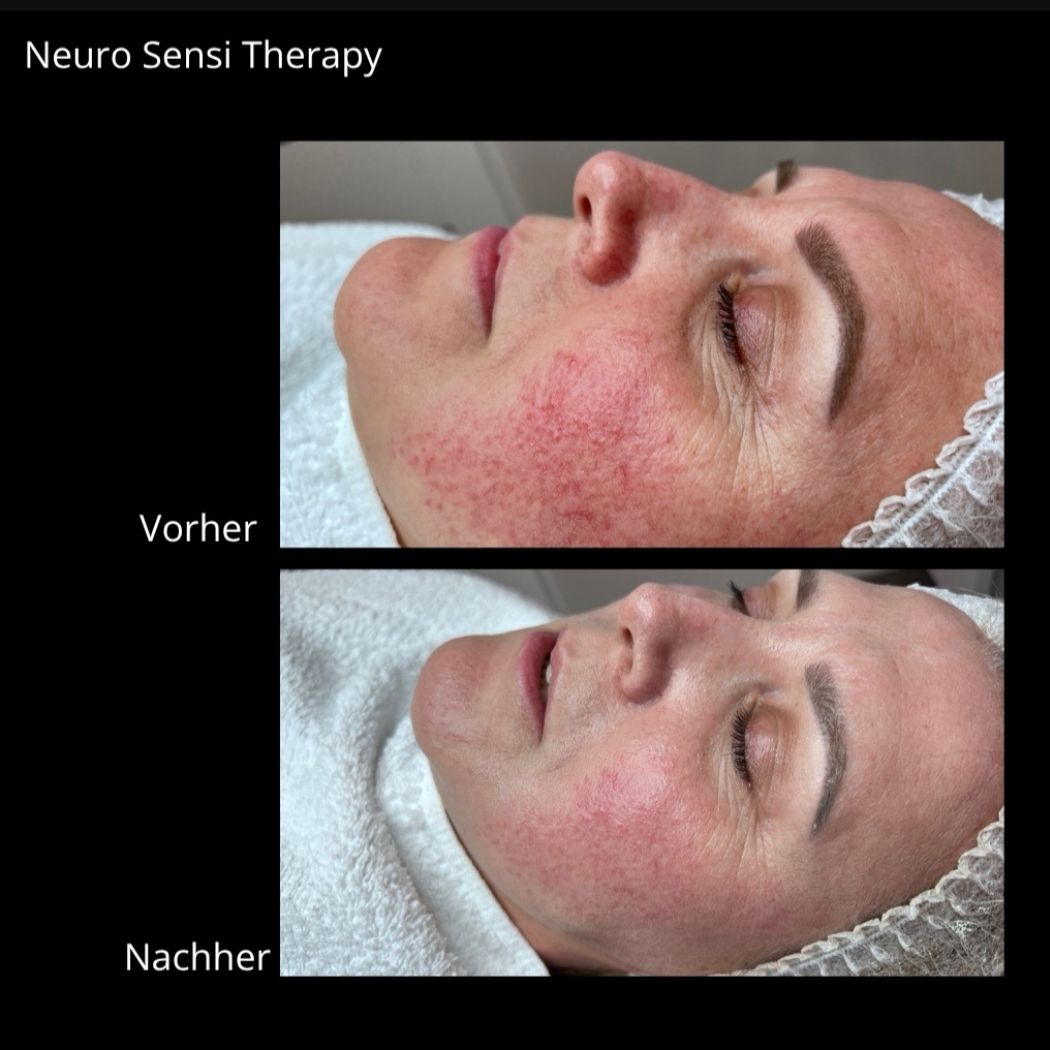 Neuro Sensi Treatment Mirella Beauty Berlin