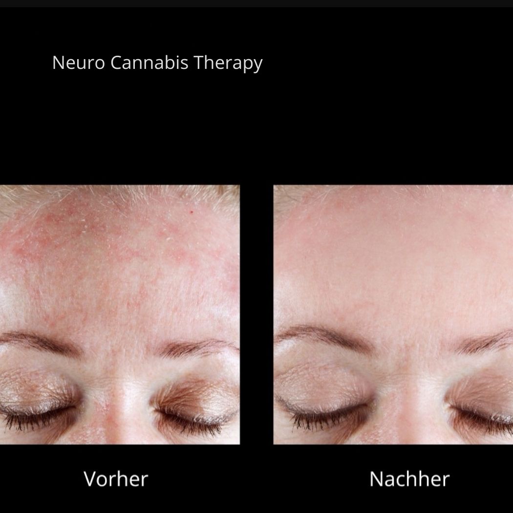 Neuro Cannabis Treatment Mirella Beauty