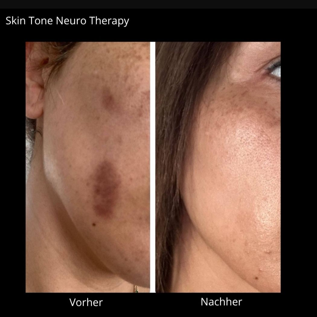 Skin Tone Neuro Treatment Gezielte Hautbehandlungen