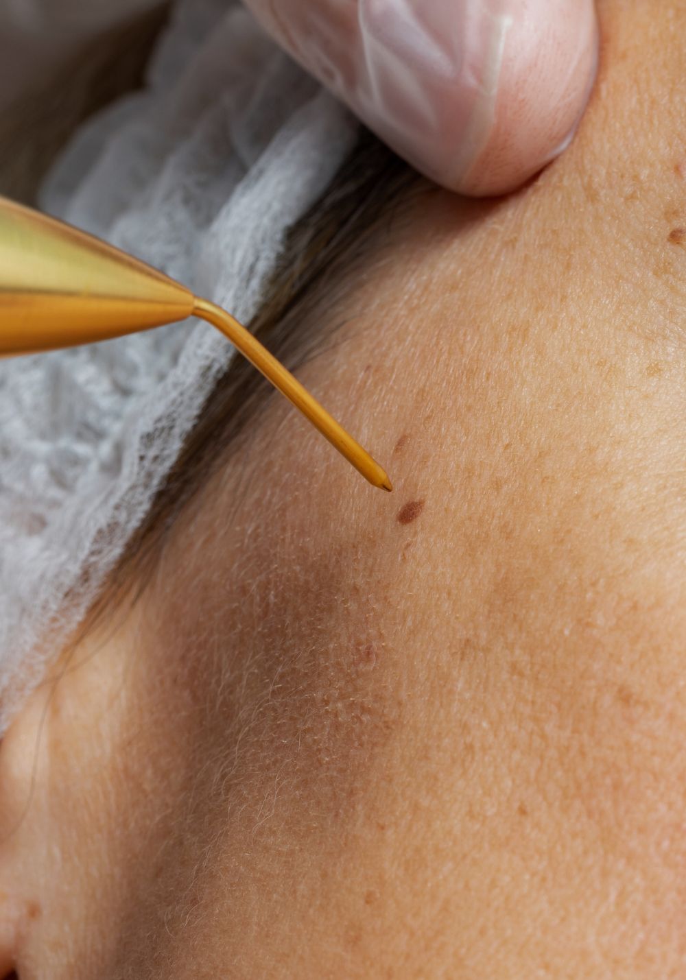 Plasma Pen Mirella Beauty Berlin