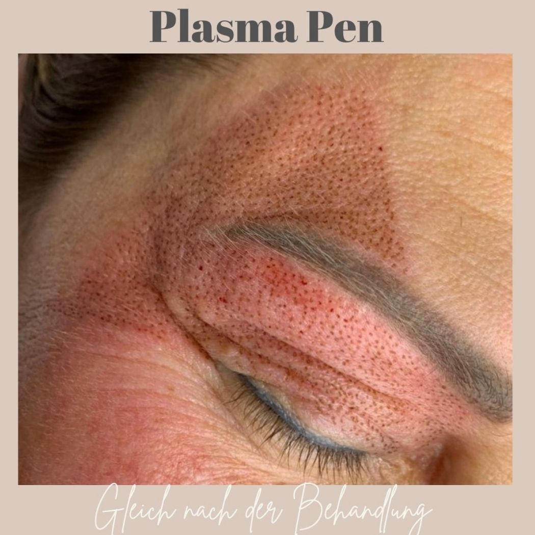 Plasma Pen Mirella Beauty