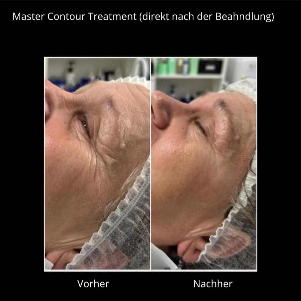 Biomicroneedling Mirella Beauty